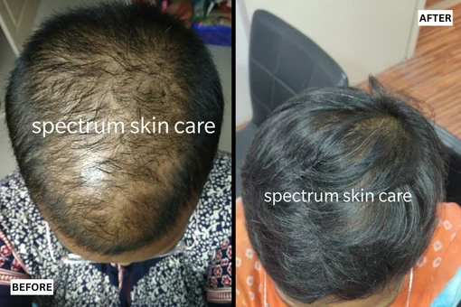 PRP with GFC Result - 2